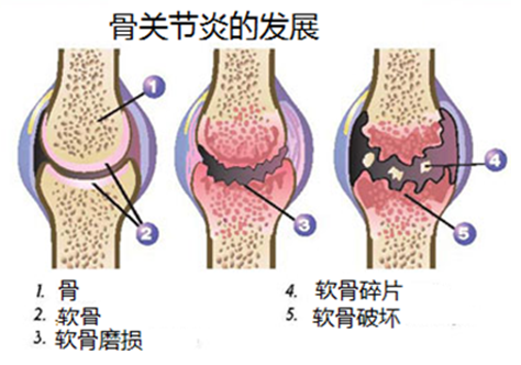膝关节疼痛的十大原因图片