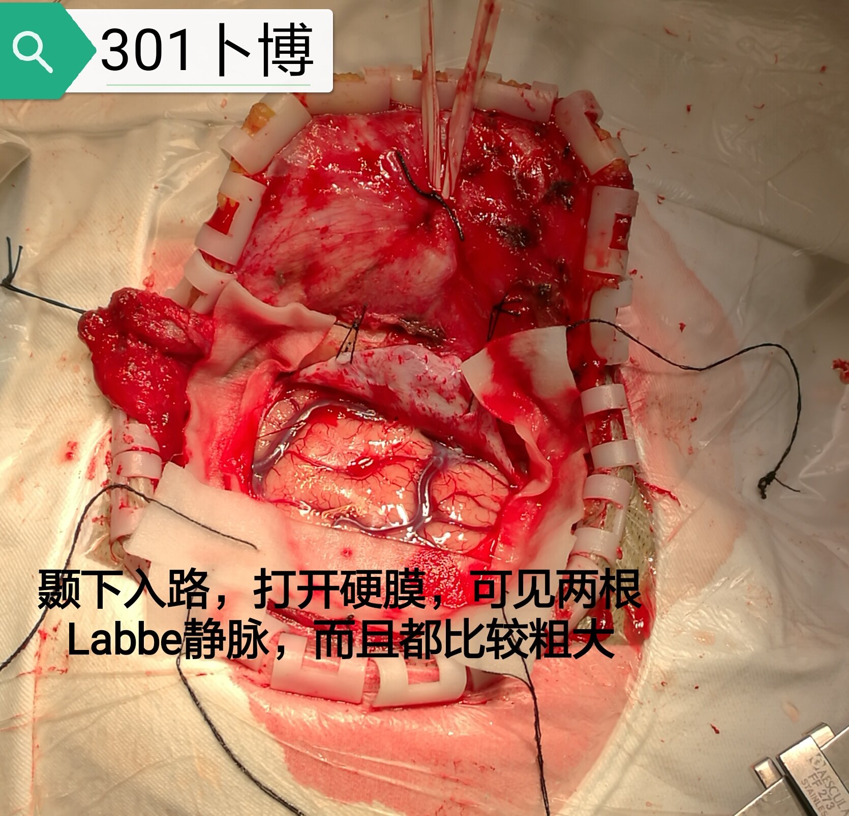 其基底位于labbe静脉汇入点的内侧.静脉全部保留.细节之美.