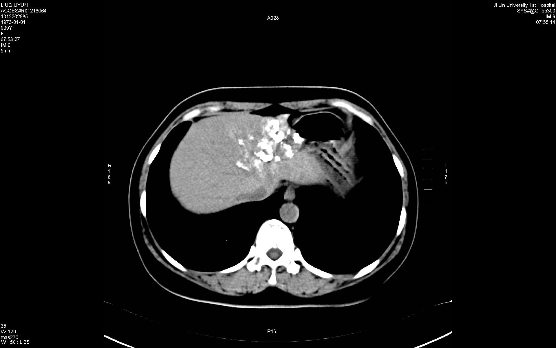 肝海绵状血管瘤的一种有效治疗手段--栓塞硬化术