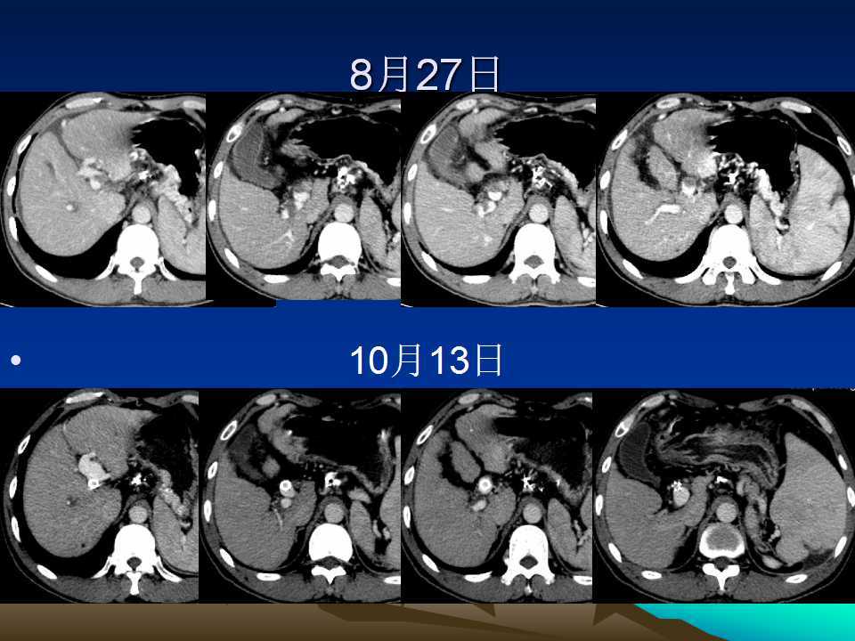 门脉性肝硬化10×10图片