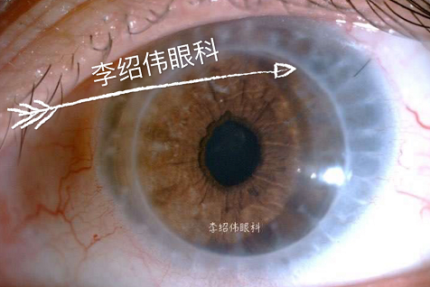 角膜移植后眼睛外观图片