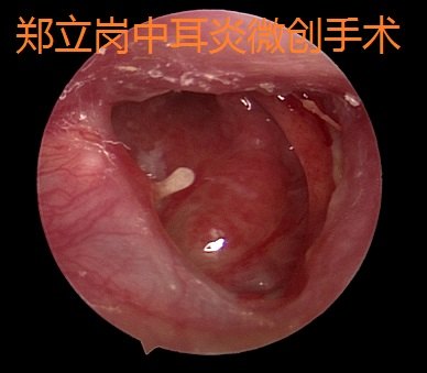 中耳乳突炎微创手术第321广西贺州昭平王