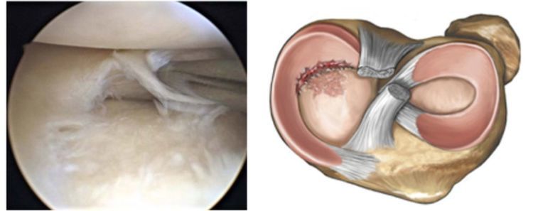 膝关节内侧半月板损伤图片