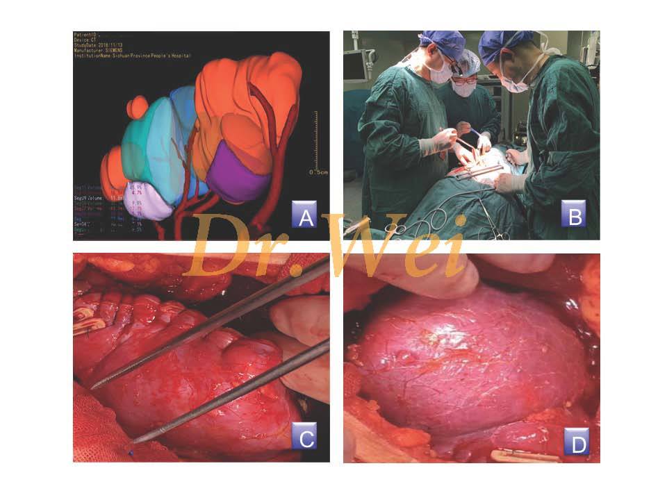 定量化虚拟三维重建 RPN Kidney new case .jpg