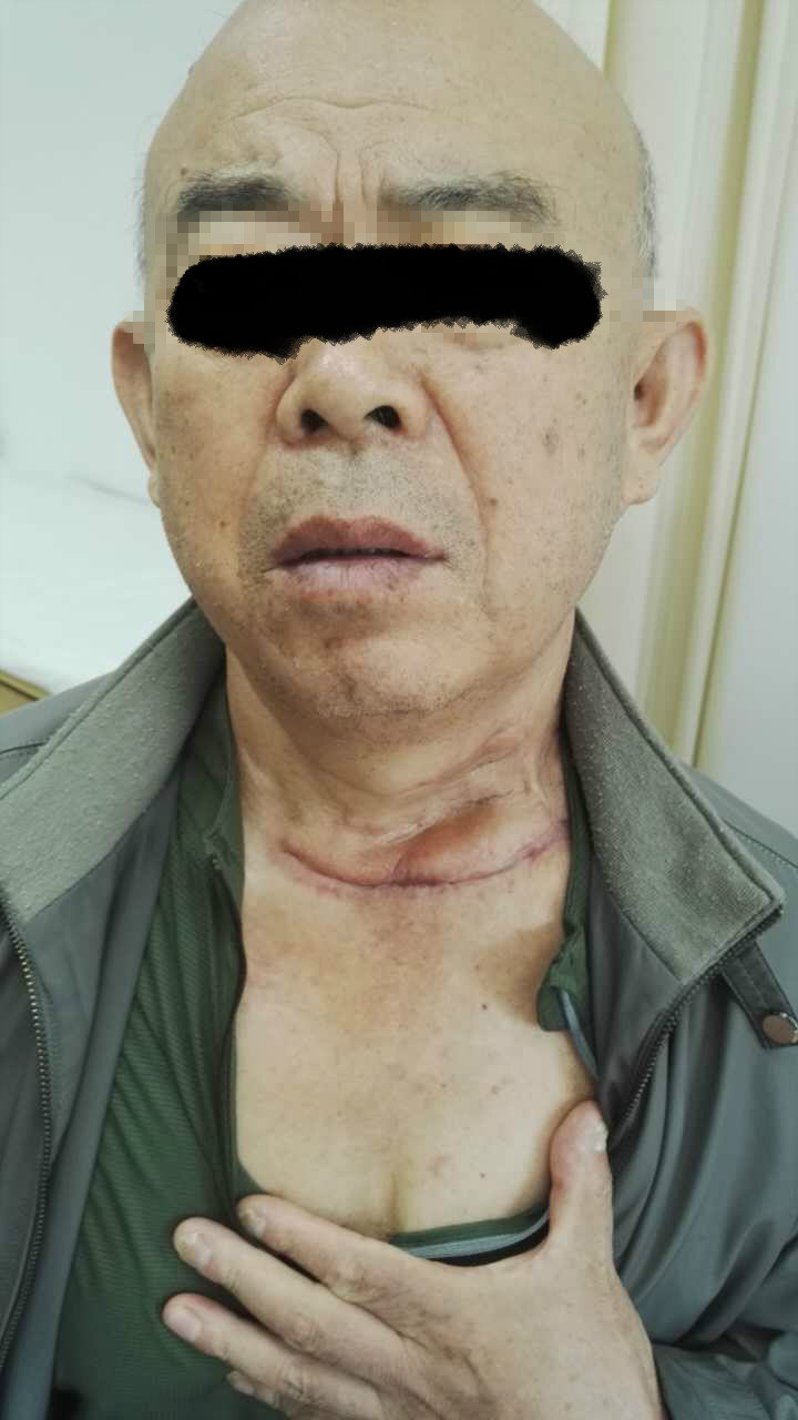 复发甲腺状癌侵犯锁骨伴腹主动脉夹层诊治 - 好大夫在线