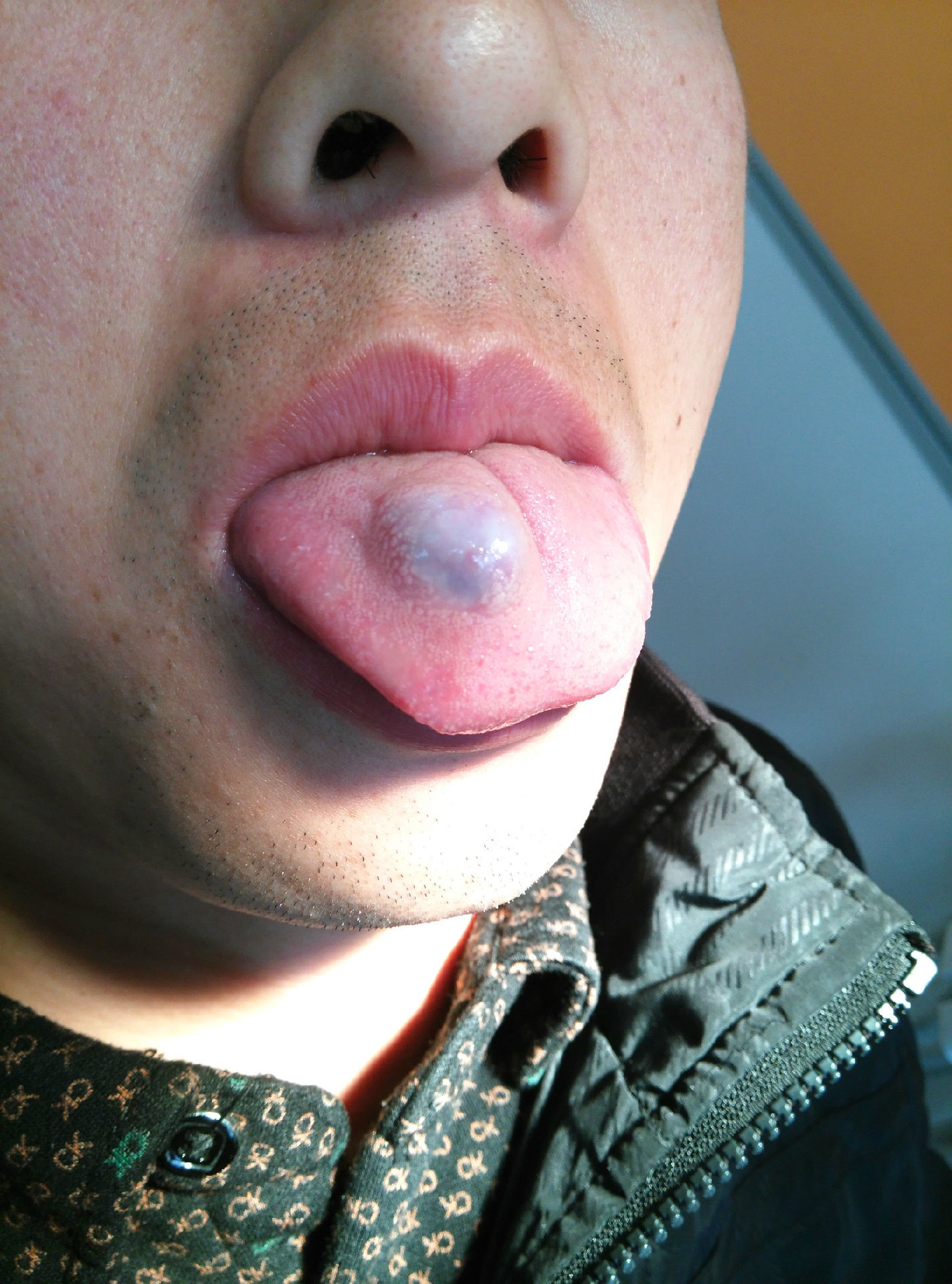舌头上面有血管瘤图片图片