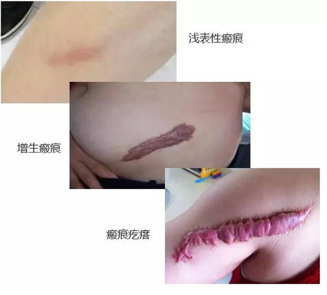 面,质硬韧,颜色发红的结节状,条索状或片状肿块,呈持续性生长.