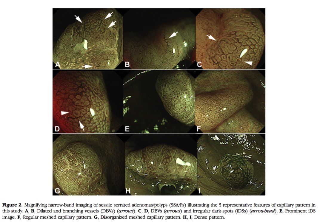 肠镜下nbi诊断锯齿状腺瘤 - 好大夫在线