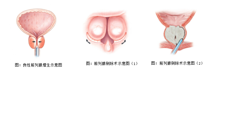 先断血供再切除腺体,极大地扩展了经尿道前列腺电切的手术范围,被广大