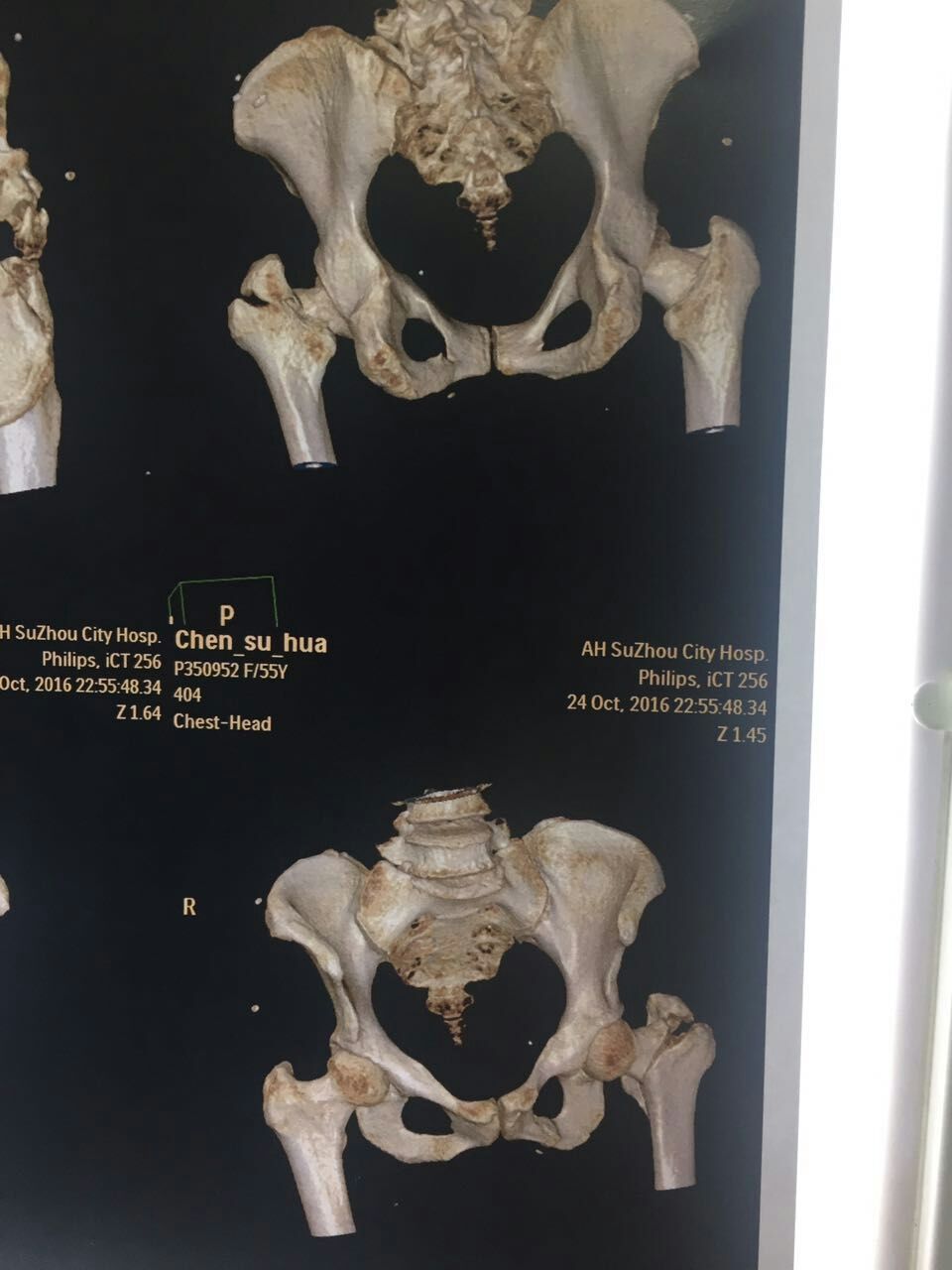 肱骨大转子骨折图片