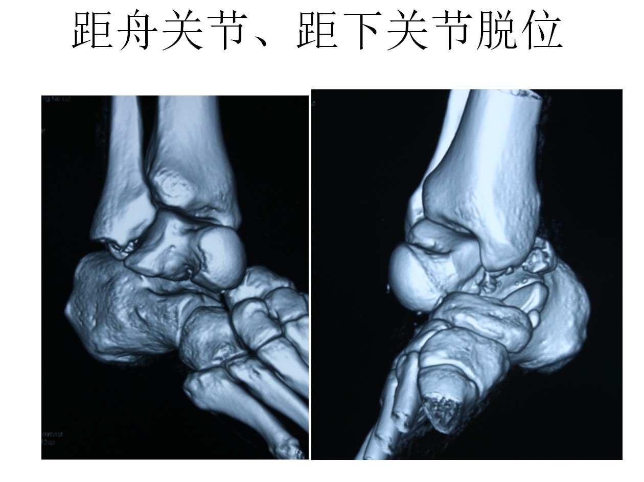 距骨骨折合併距下關節脫位