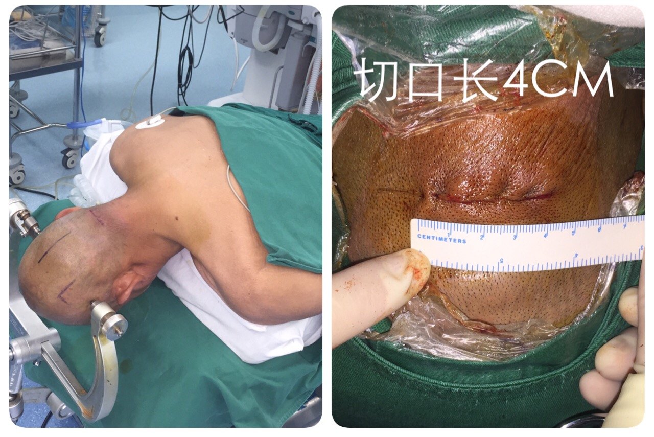 悬吊硬膜后,放射状剪开硬脑膜,显露右侧小脑半球,见肿瘤位于右侧小脑