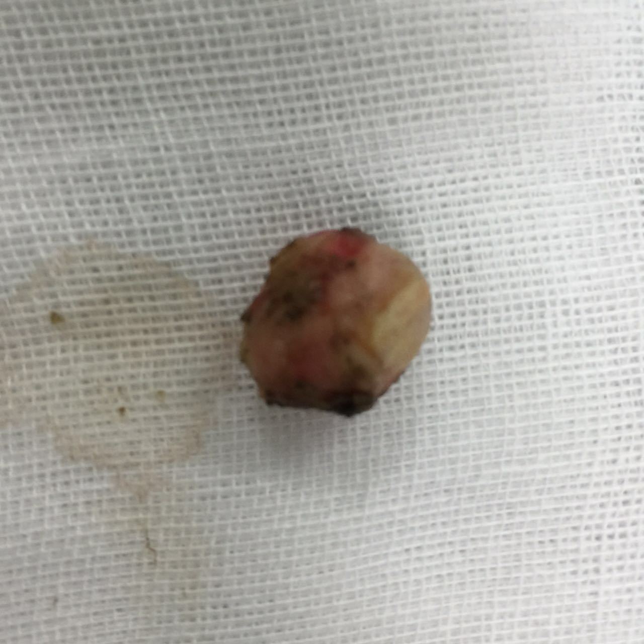 胃内长瘤子,胃镜治疗免挨刀