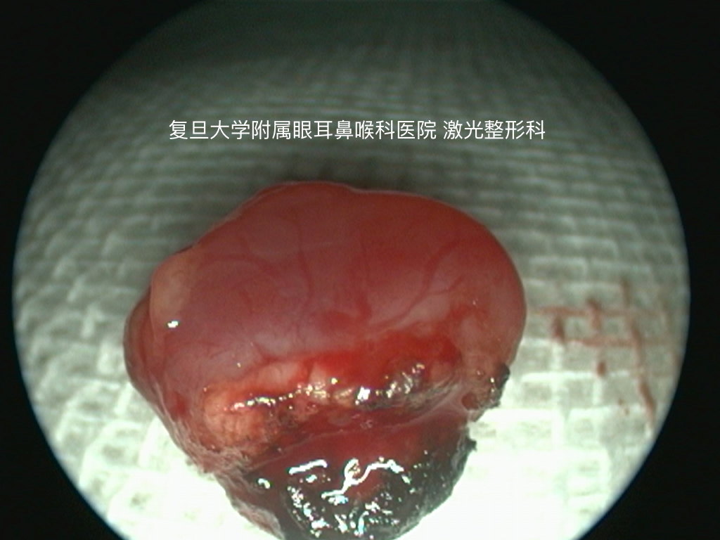 鼻前庭血管瘤图片