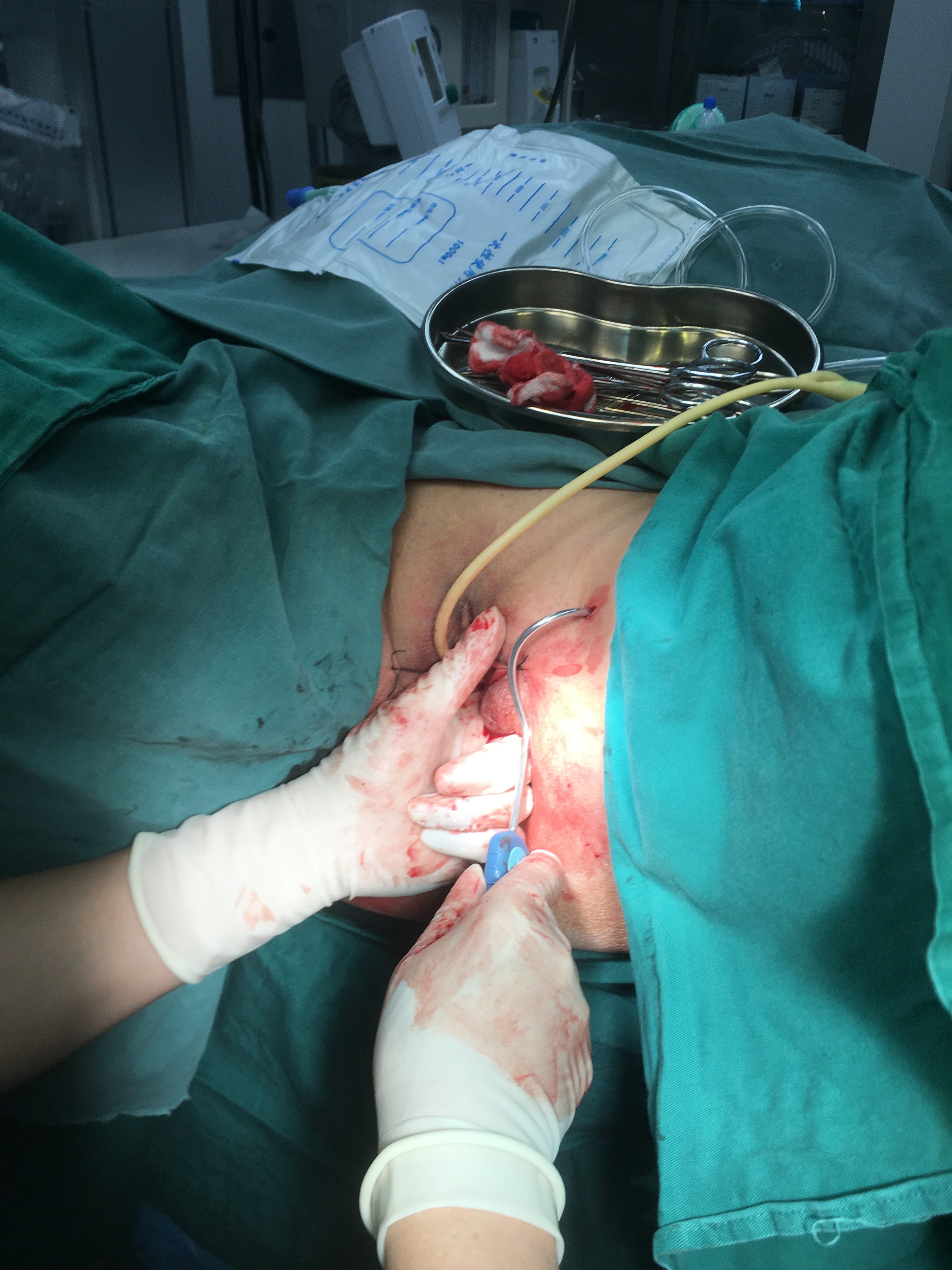 压力性尿失禁手术治疗效果好 - 好大夫在线