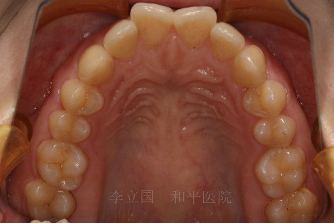 025英寸不锈钢方丝,在上颌第二前 磨牙 与第一 磨牙 的牙槽间隔区植入