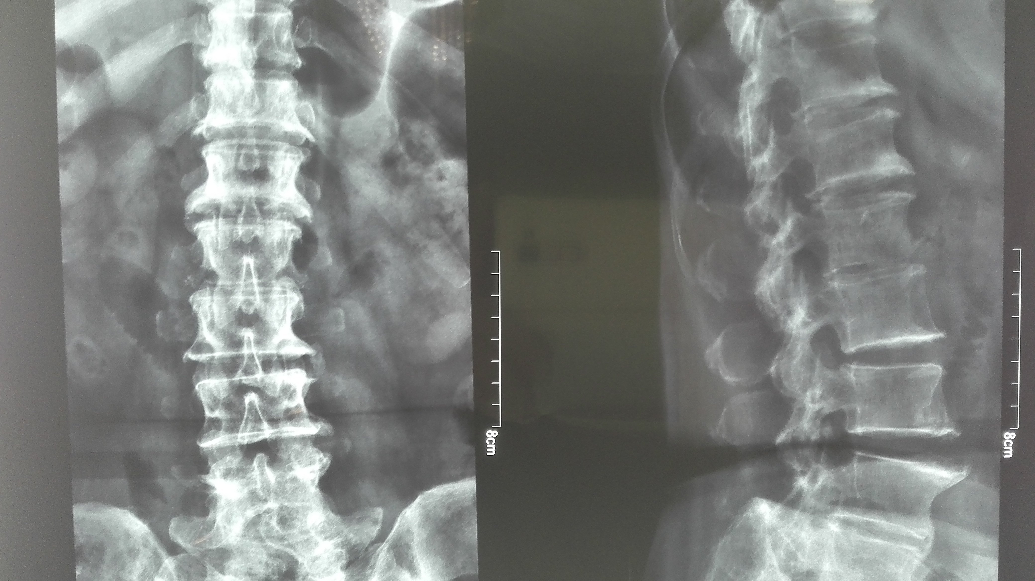 为什么拍了x片 还要拍ct Mri