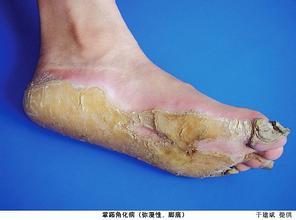 知 足 常乐 解析那些令人困扰的足部皮肤病 脚气 脚气疾病介绍 知 足 常乐 解析那些令人困扰的足部皮肤病 脚气 脚气疾病介绍