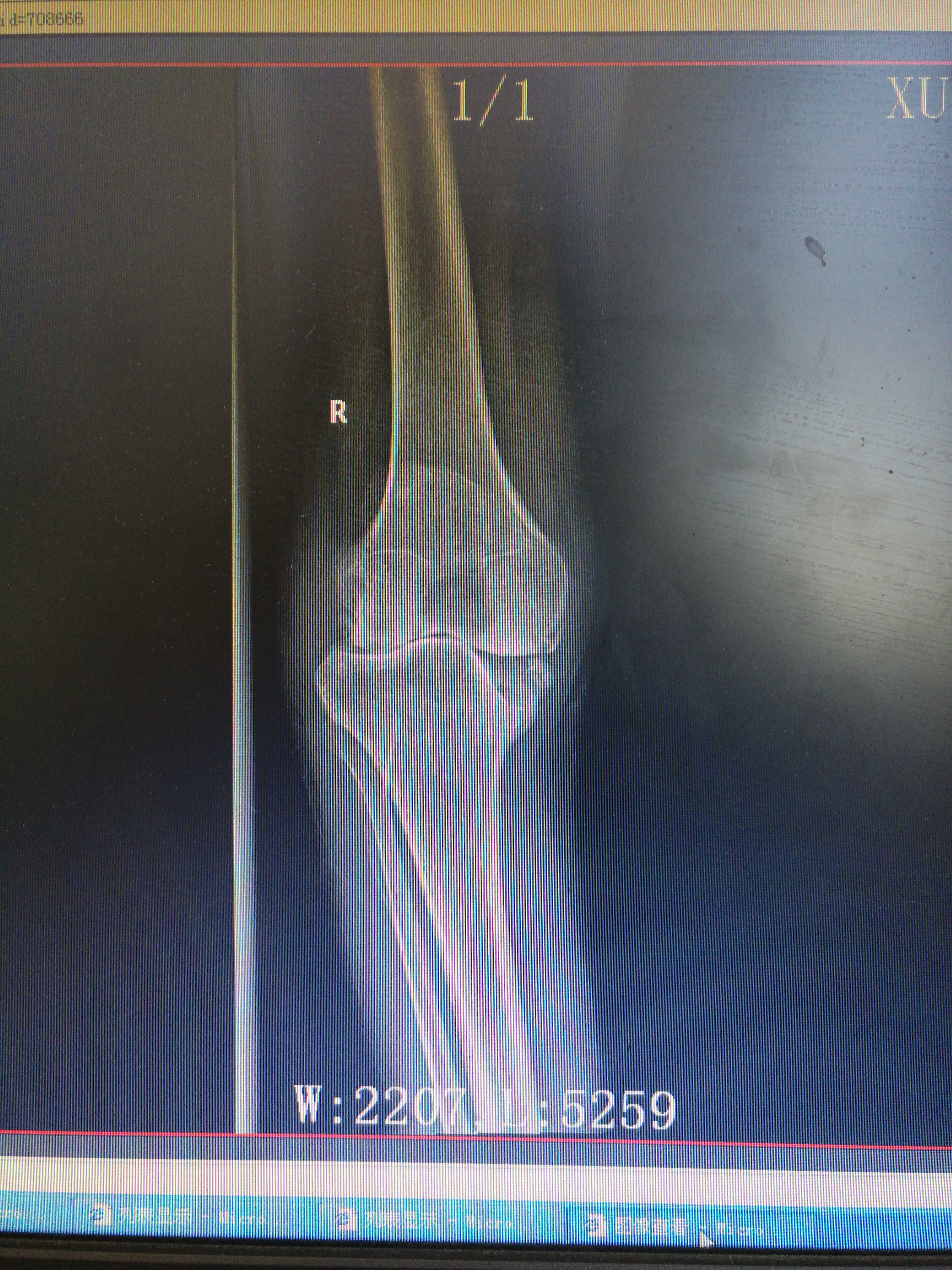 小腿胫骨骨膜增厚图片图片