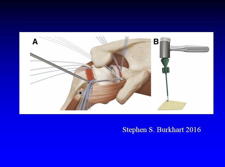 美国牛仔burkhart上关节囊重建治疗肩袖损伤(下)