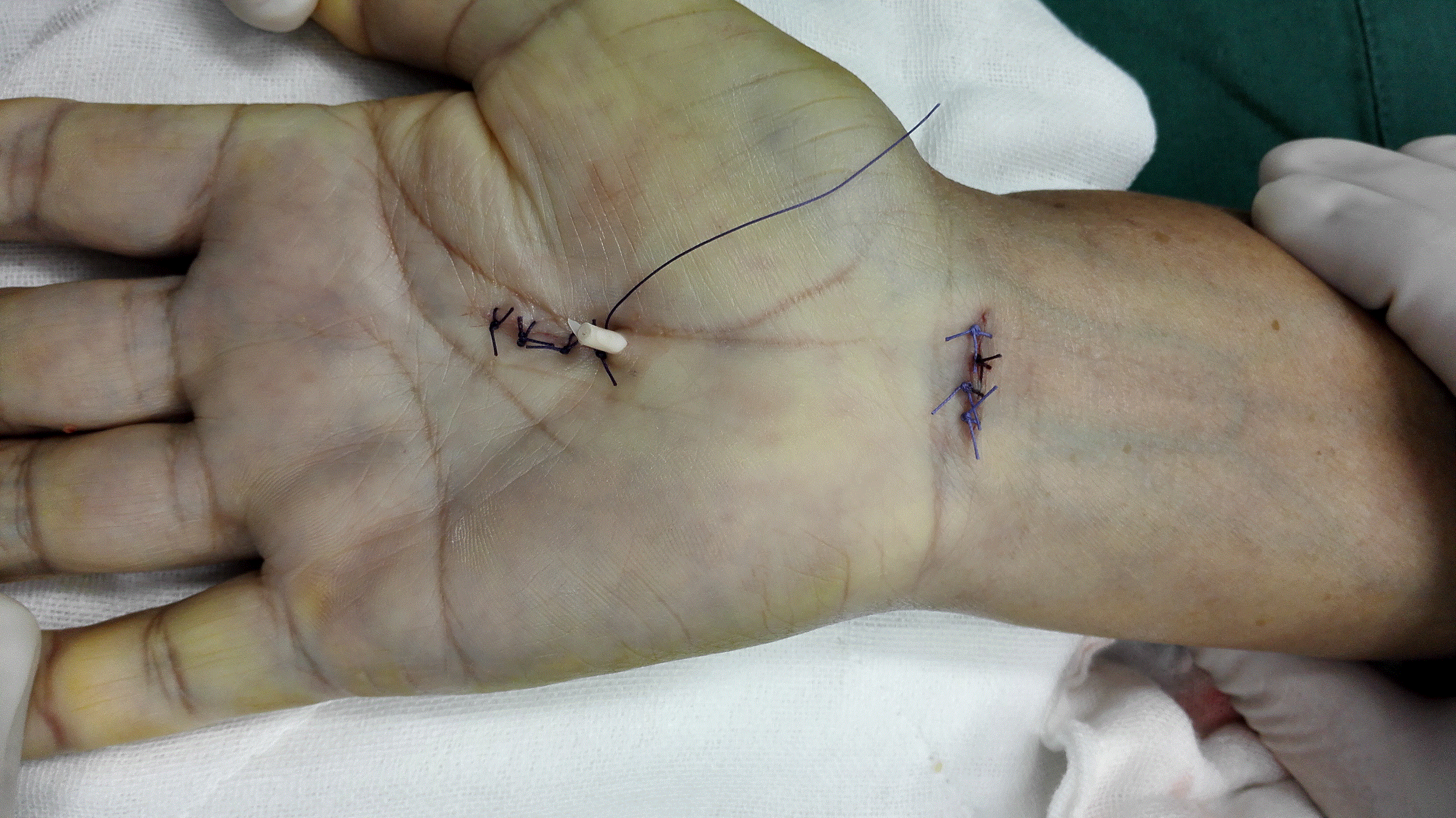 尺神经损伤手术刀口图图片