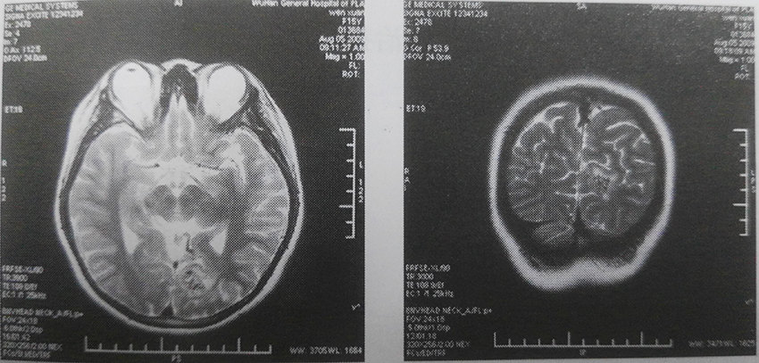 头部伽马刀治疗脑血管畸形病例分享(1)