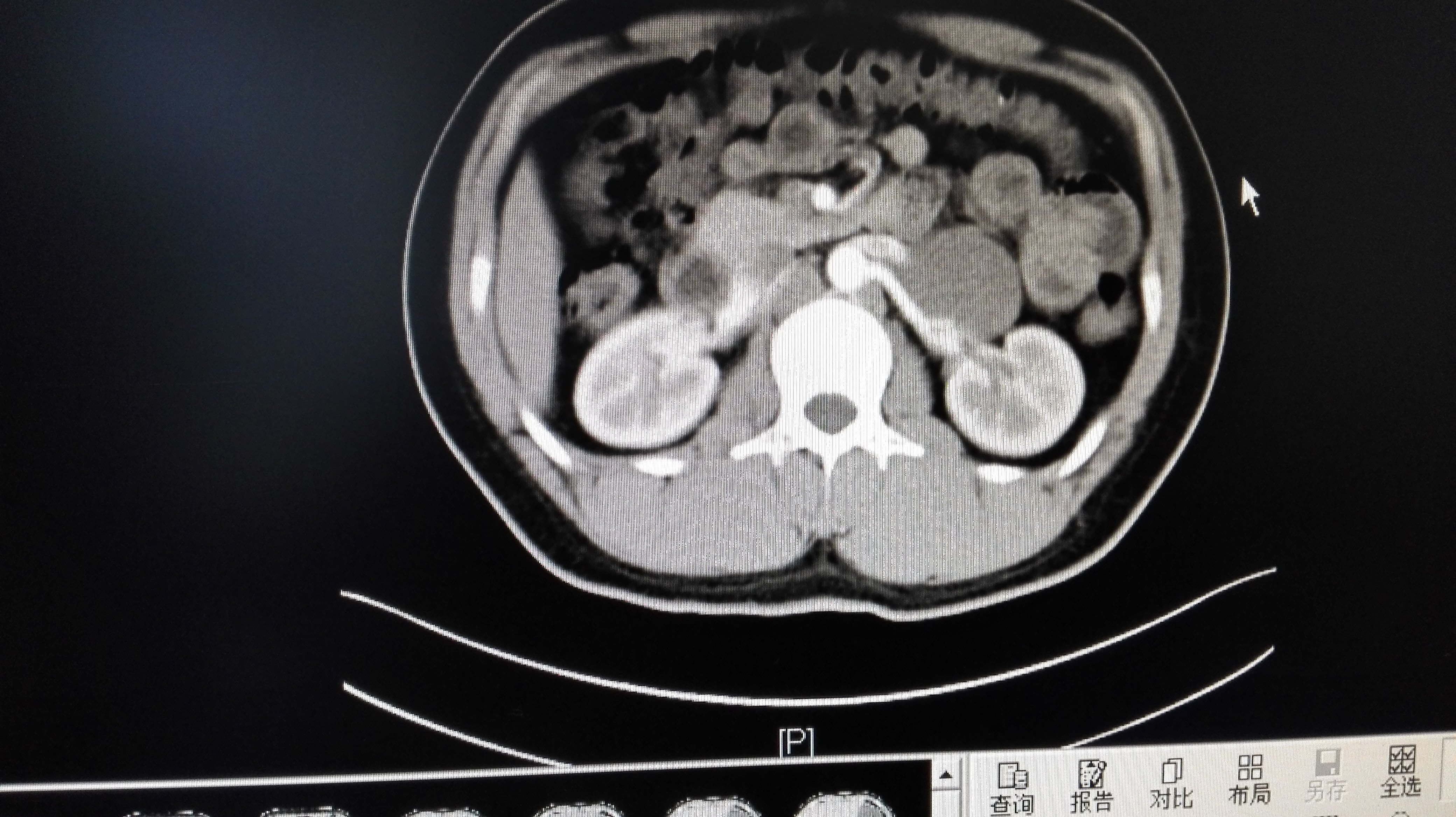 腹膜后肿瘤位置图片图片