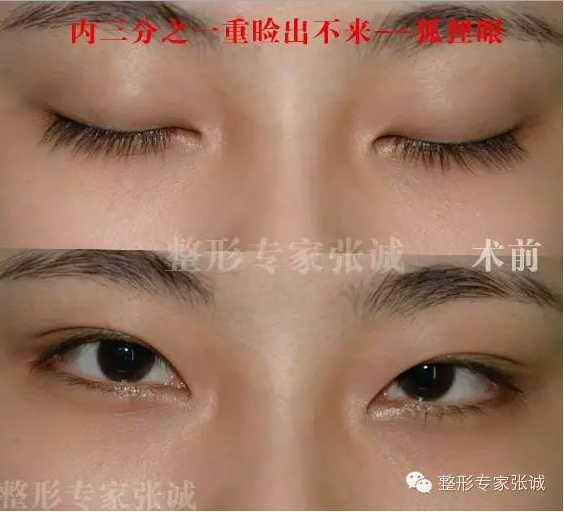 各种失败双眼皮的症状表现 修复方法及最佳时间 双眼皮手术 症状 病因 日常护理 治疗方法