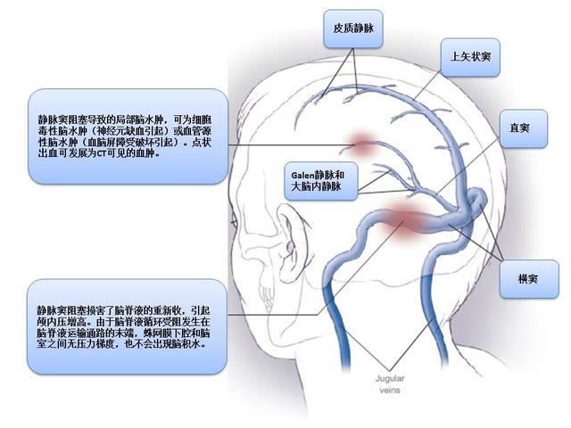 产褥期静脉窦血栓形成虽然临床上非常少见,但其病情常迅速恶化,若不能