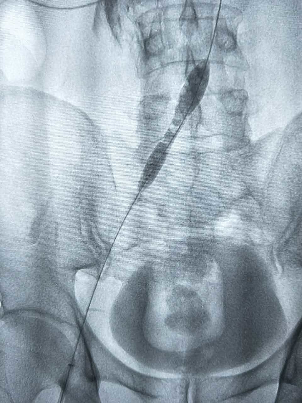 腿肿的原因分析