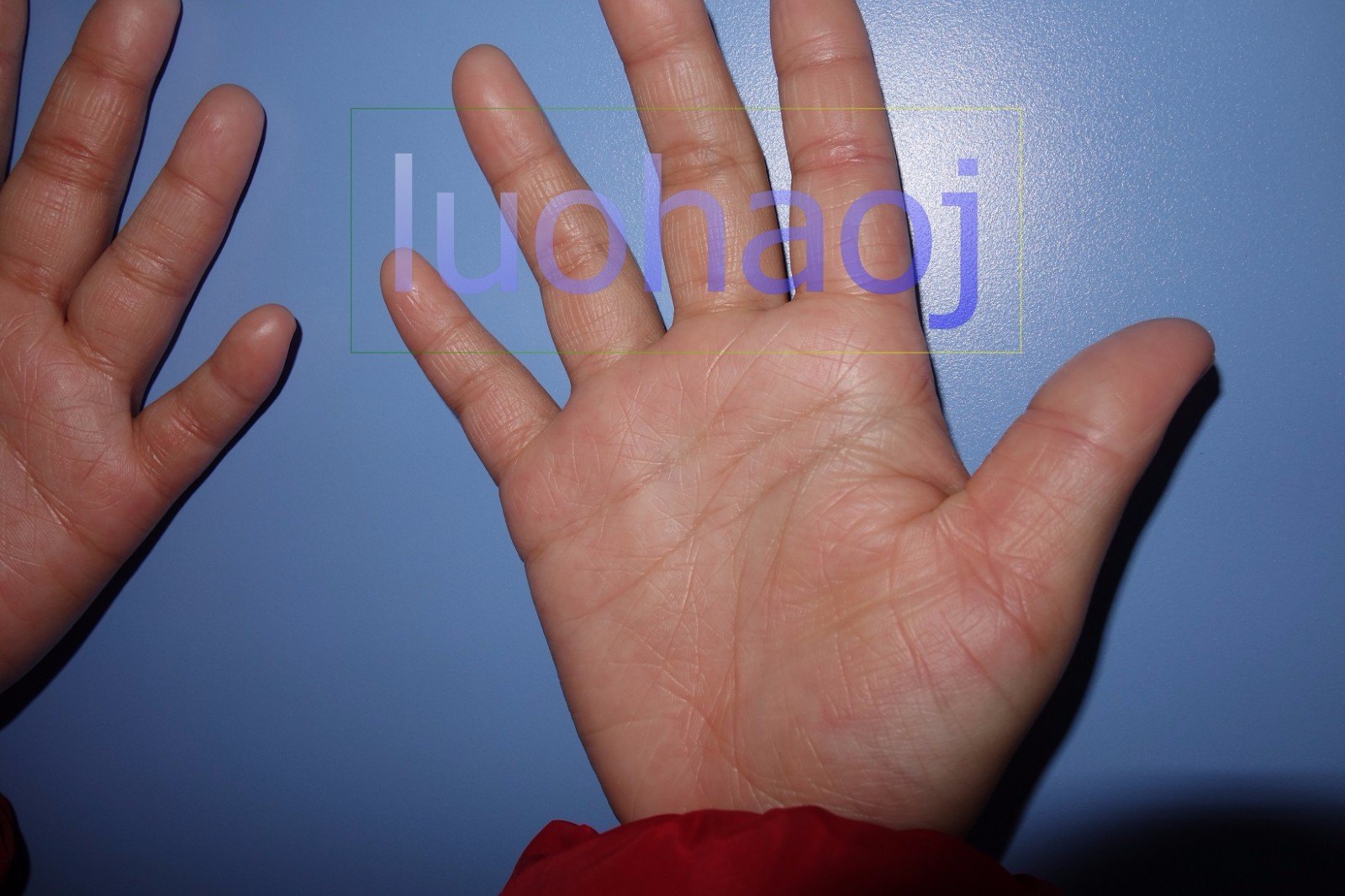 女孩手掌心掌跖角皮症5年余