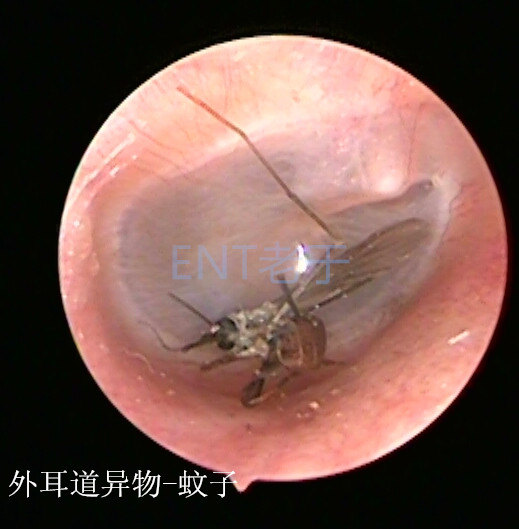 漫谈外耳道异物