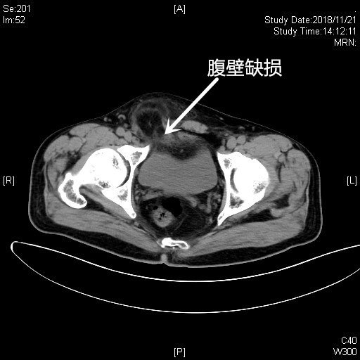 61腹部ct;61b超:右側腹股溝區可見一疝囊結構,內容物為腸管,疝口