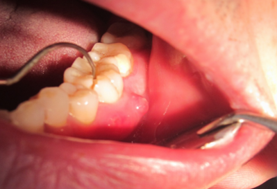 年轻的牙齿裂开了 - 好大夫在线