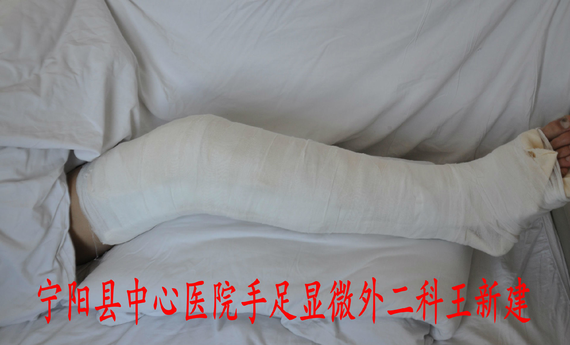 浅谈急性跟腱断裂的修复方法
