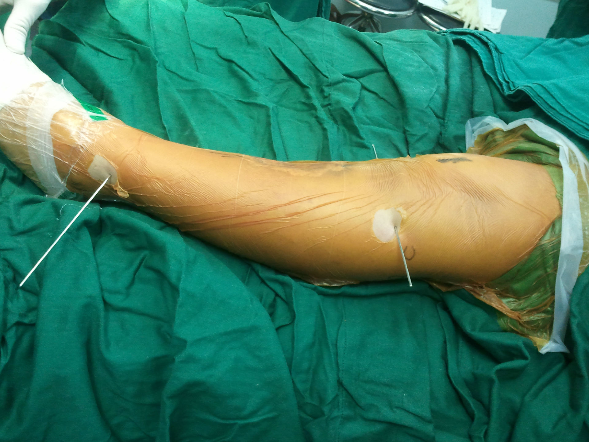 下肢畸形, o型腿,x型腿,长短腿, 优美协调的腿 - 好大夫在线