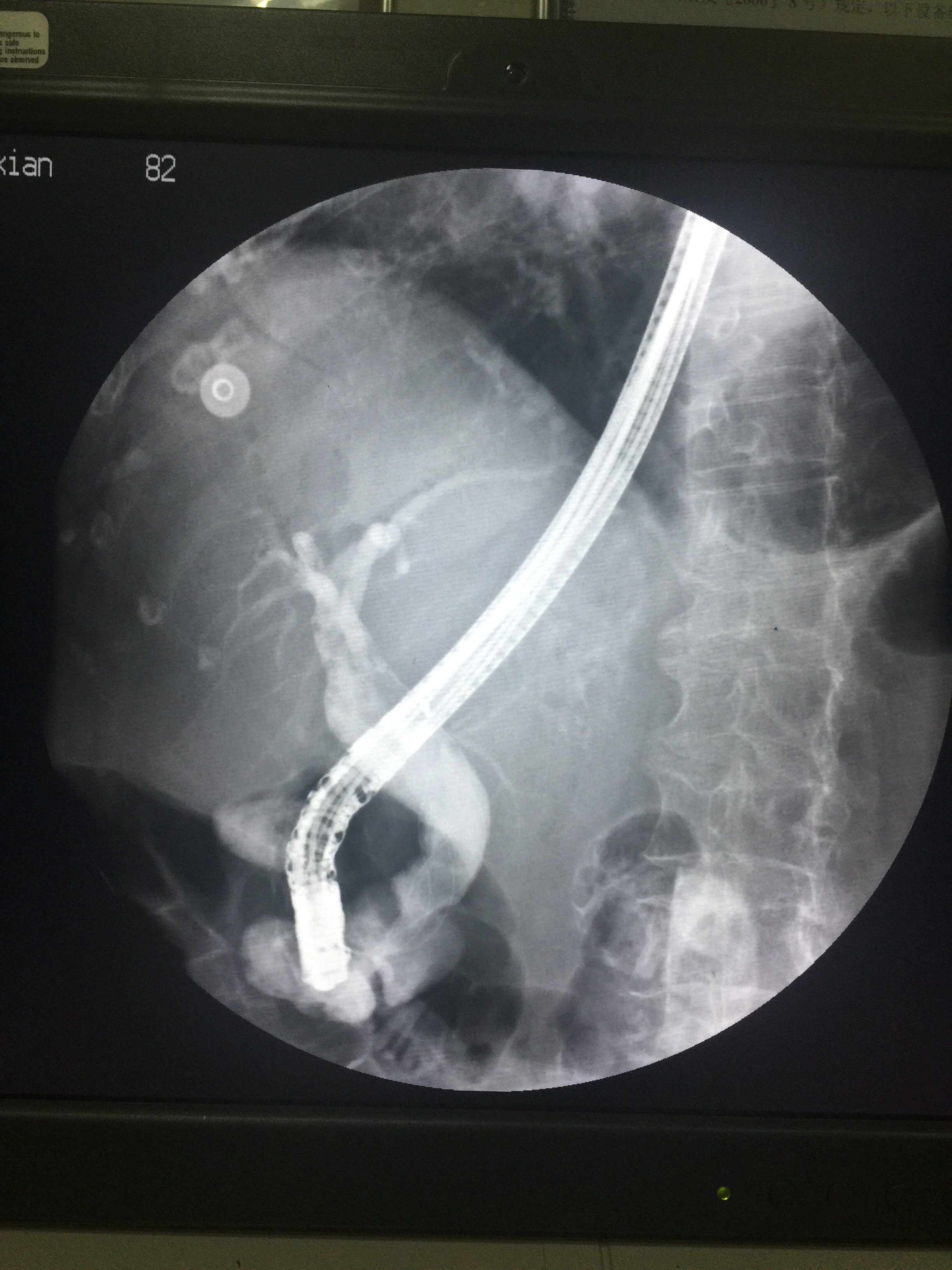 胆管大石头微创取出(2cm胆管色素软结石ercp取出) - 好大夫在线