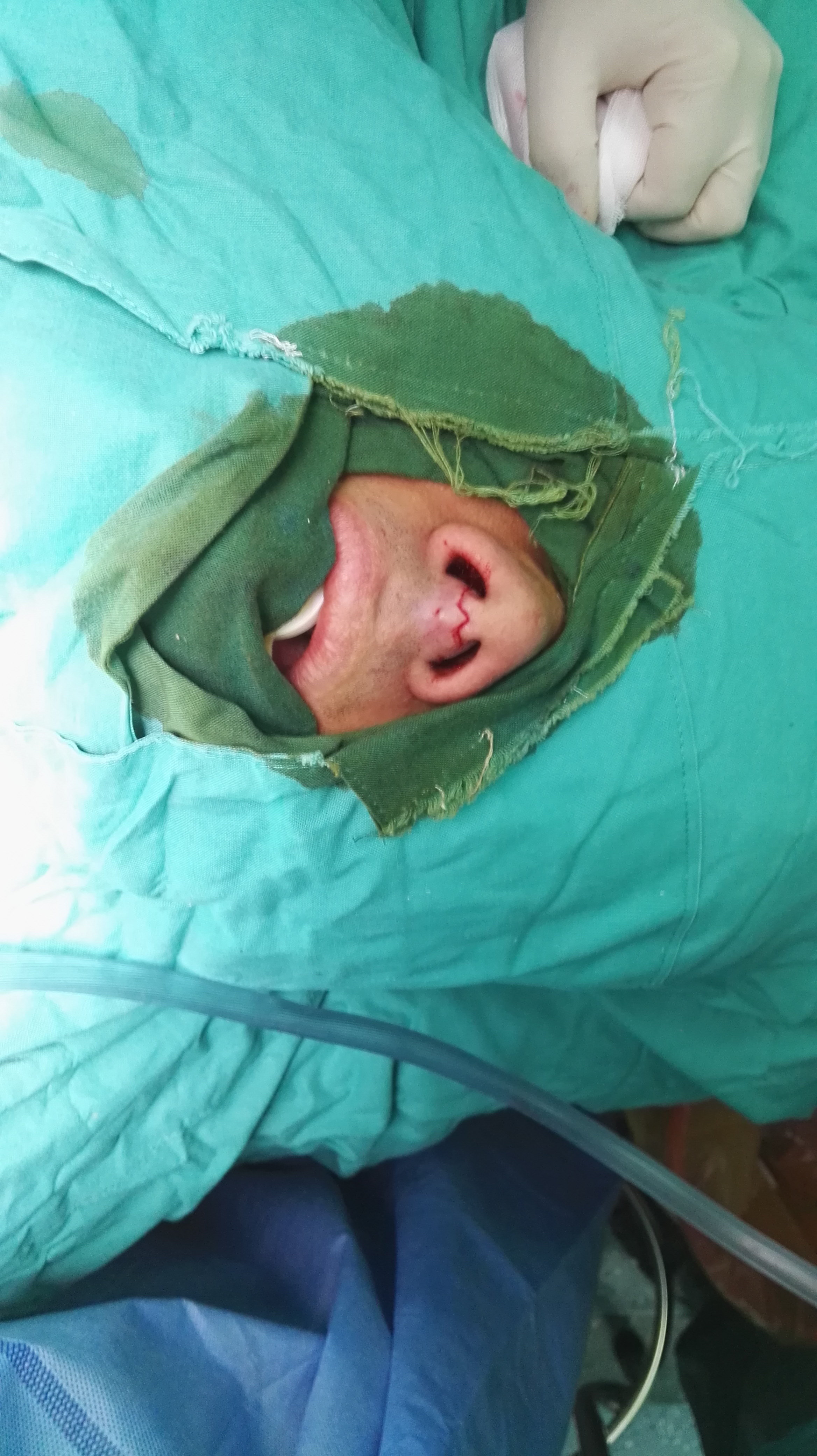 如图一,患者鼻小柱明显增宽.肿物累及上唇.图2,肿瘤边界清楚,较大.