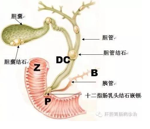 胆囊结石的大小之祸,祸如何解?