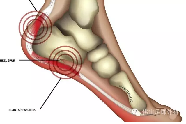 圖文並茂讓你遠離足跟痛