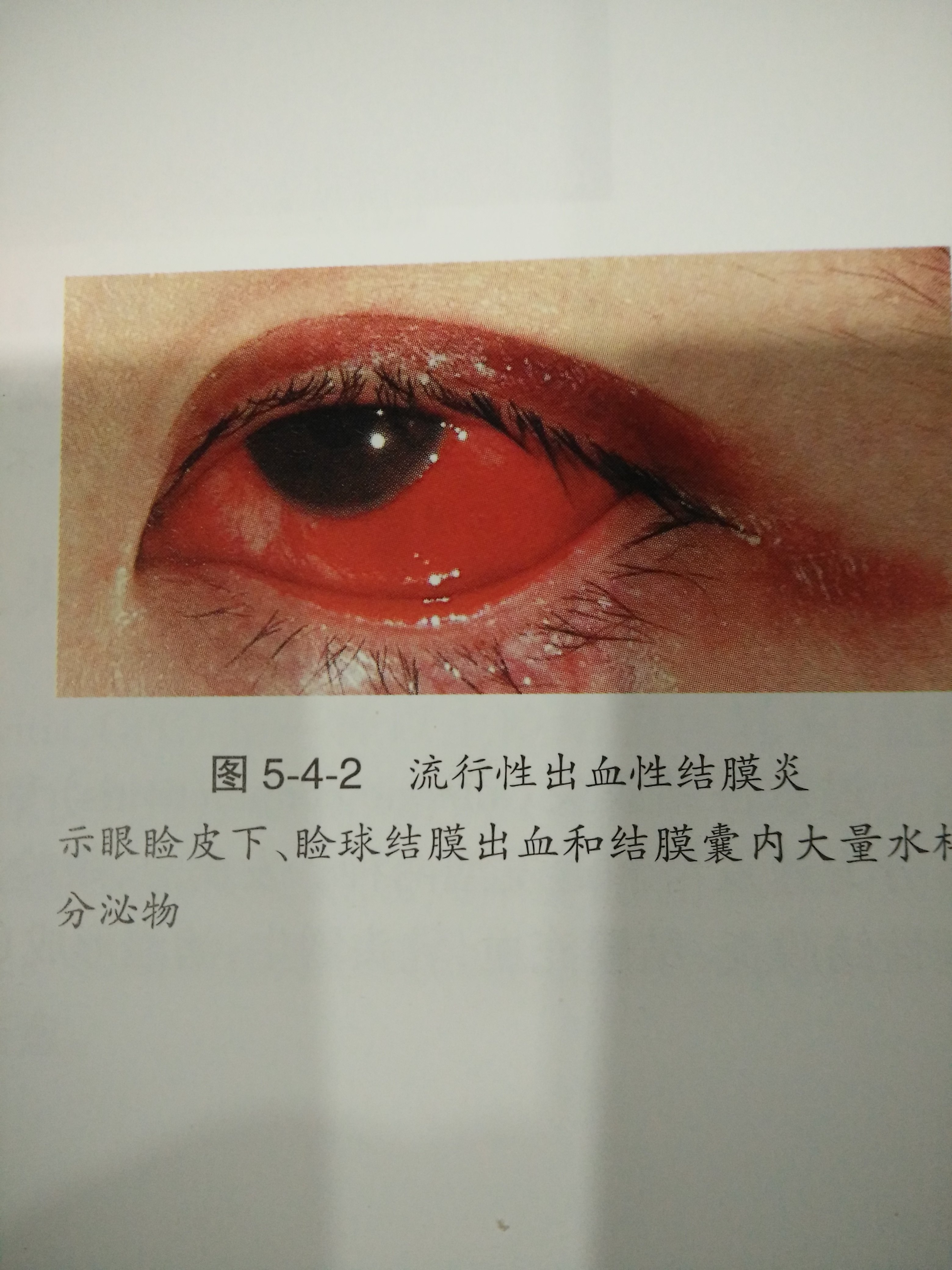 《一,概念 流行性出血性结膜炎又称急性出血性结膜炎(俗称红眼病