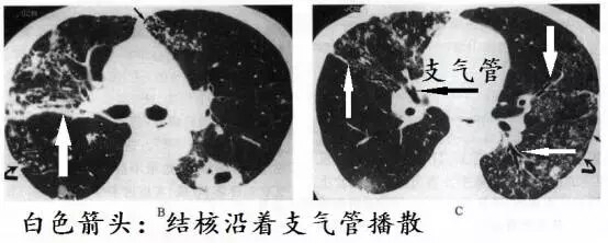 所謂結核沿著支氣管播散,簡單的說就是病灶大部分都分佈在支氣管周圍.