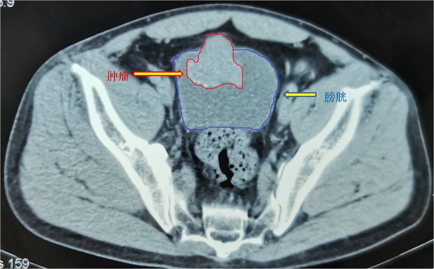 患者ct影像提示膀胱肿瘤浸润膀胱全层并向外生长,分期t3以上,似乎确有