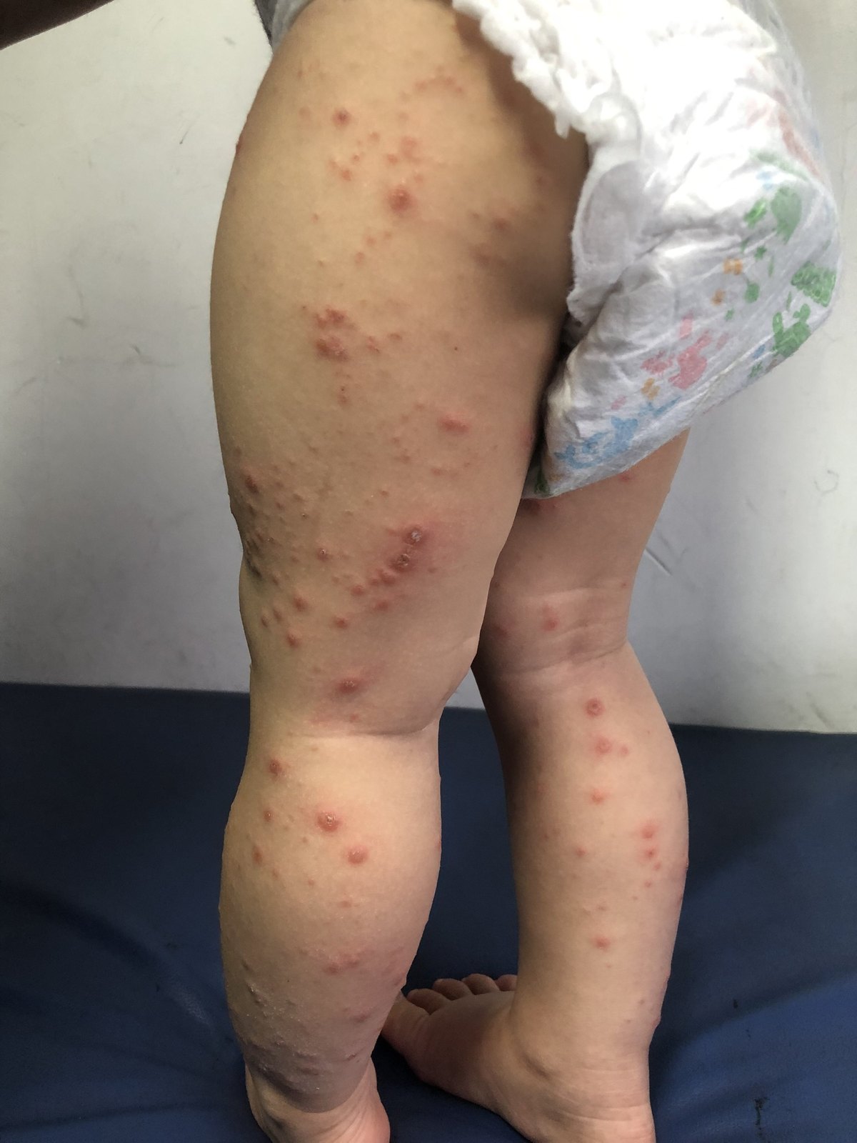 手足口病_手足口病症状表现