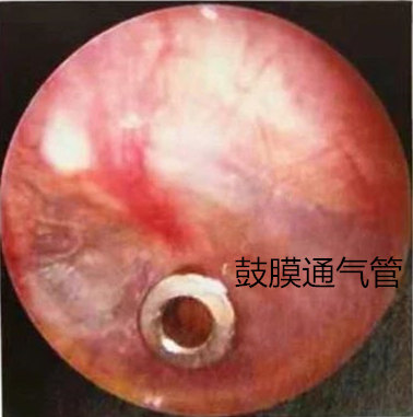 T型鼓膜通气管图片