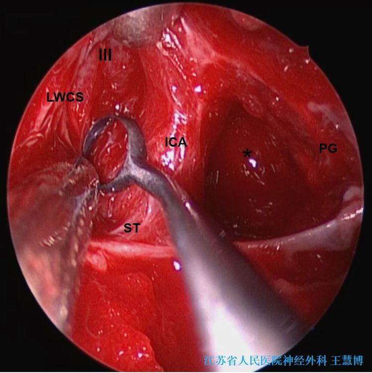 内镜经鼻扩大入路切除侵袭海绵窦的功能性垂体腺瘤_鼻内镜手术_治疗