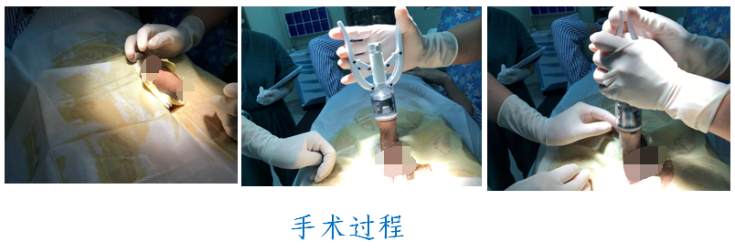 包茎套环手术过程图片