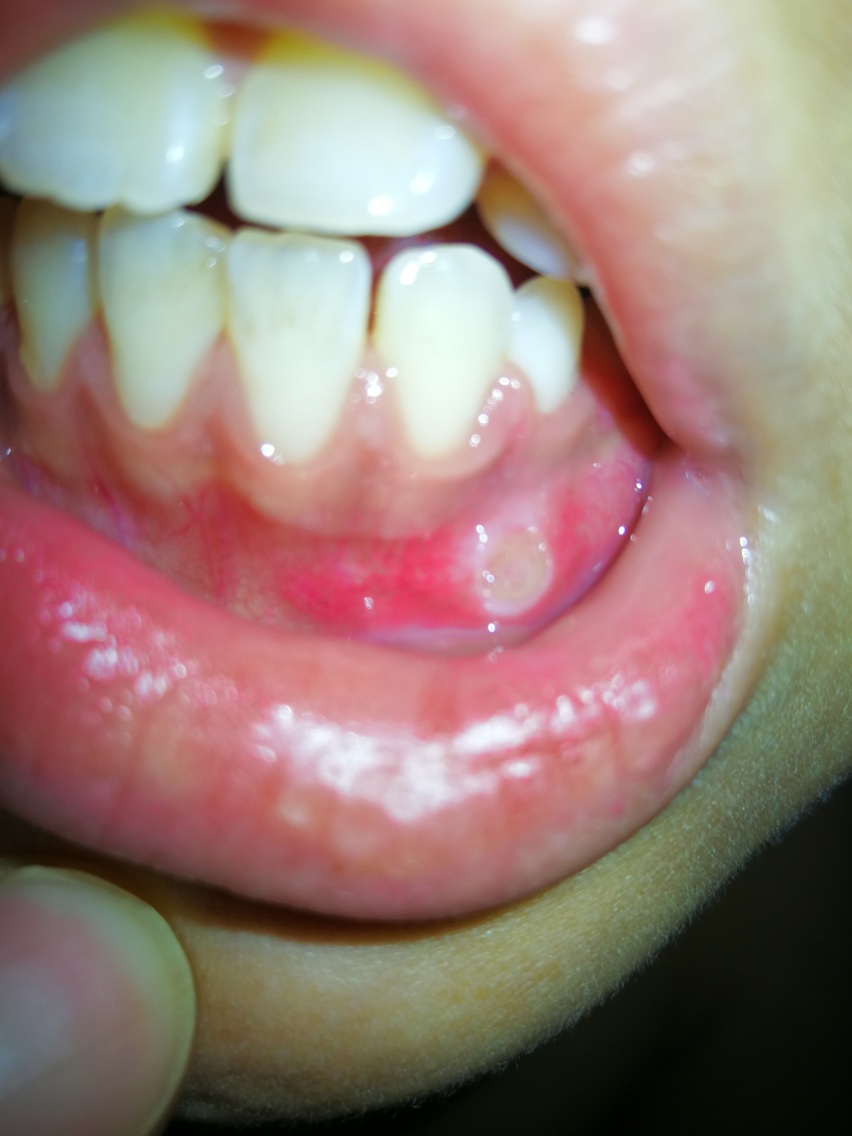 口腔溃疡的表现症状图片