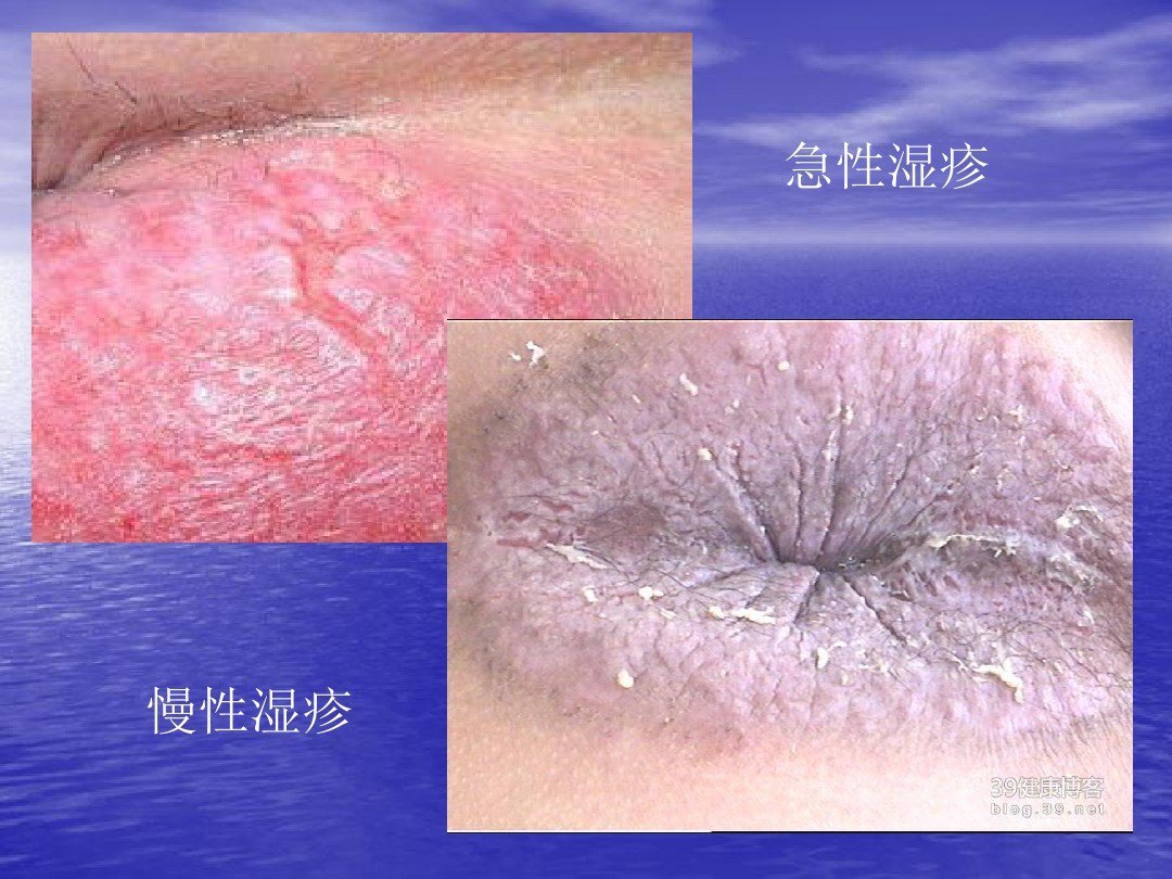 儿童肛门瘙痒的原因有哪些 瘙痒症 好大夫在线