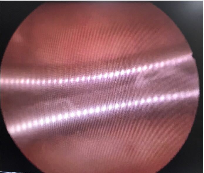宫腔粘连手术球囊图片图片